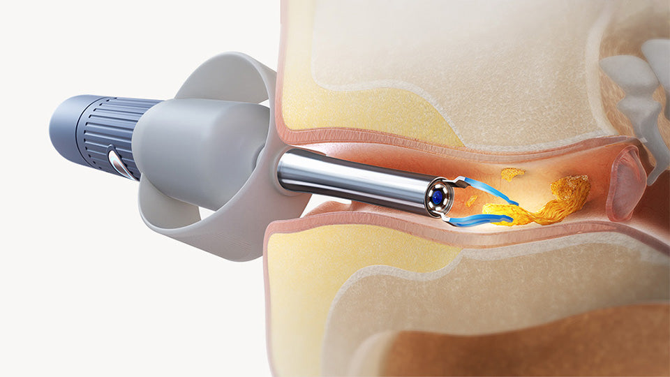 Four Smart Ear Cleaning Modes with Visual Otoscope Technology