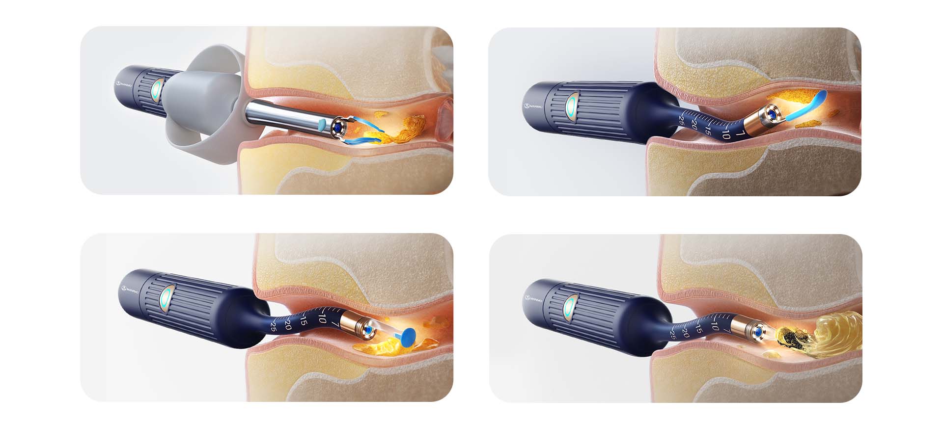 Four Smart Ear Cleaning Modes with Visual Otoscope Technology